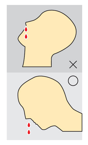 코피 나면 고개를 뒤로 젖힌다? NO
