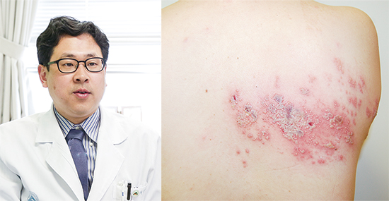 [Health] 면역력 떨어진 겨울철 불쑥 찾아오는 ‘대상포진’ 물집 생긴 후 3일이 ‘골든타임’ 예방접종 필수