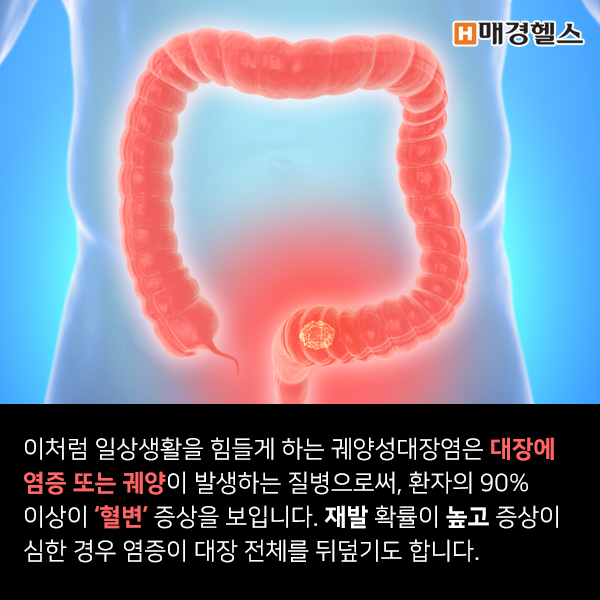 [건강스펀지] 피똥 싸는 고통! 궤양성 대장염