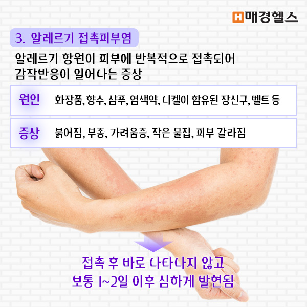 [건강스펀지] 알아두면 쓸모있는 신비한 알레르기 사전