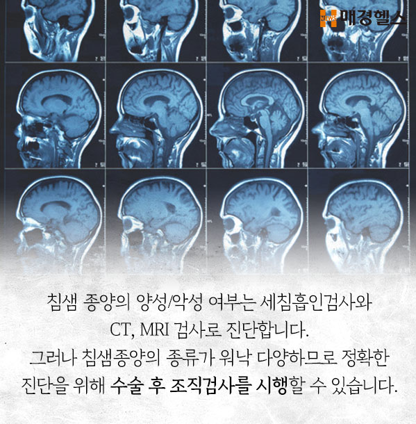 [카드뉴스] 혹부리영감의 혹, 양성 침샘종양?