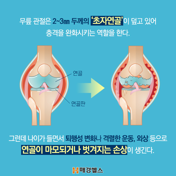 ●무릎 연골 수술 서둘러야 한다