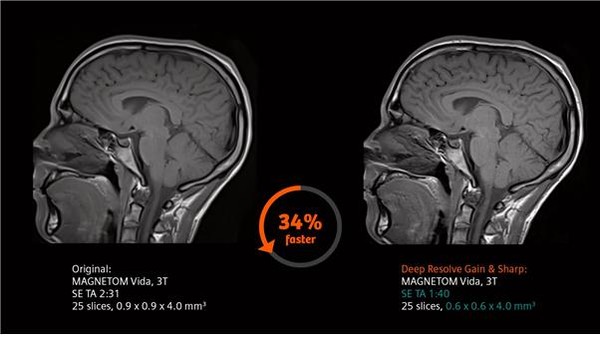 지멘스 헬시니어스의 딥 리졸브 기술이 적용된 MRI 마그네톰 비다 사진 촬영 예시. 사진 = 지멘스헬시니어스