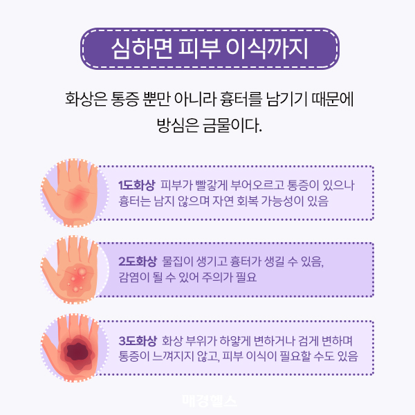올바른 화상 응급처치 방법 [알쓸건잡]
