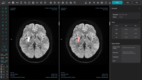제이엘케이의 인공지능 기반 뇌경색 진단 소프트웨어 JBS-01K의 구동 화면. [제이엘케이]