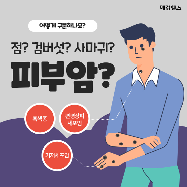 '검버섯? 사마귀?' 새로 생긴 점, 피부암과 구분하는 법은