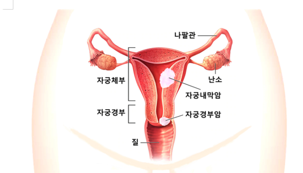 줄어드는 자궁경부암 늘어나는 자궁내막암 대처법은 9222