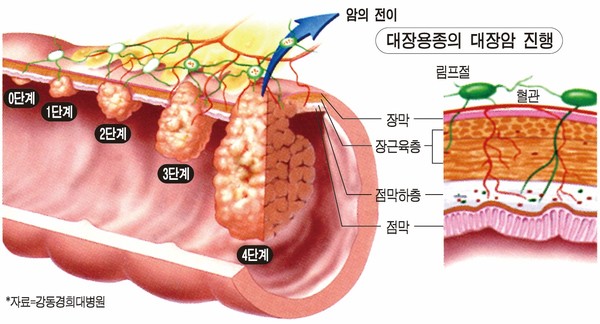 직장암, 전이·재발·수술 합병증이 잦은 까닭은?