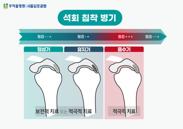 [전문의 기고] 당신 어깨 안의 돌, 석회성건염
