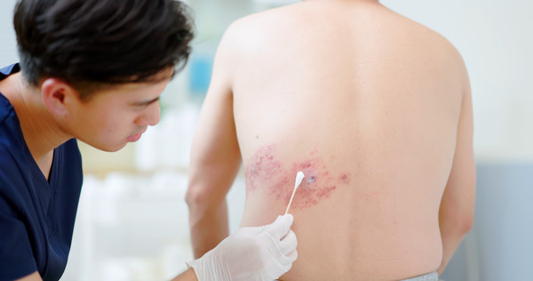 밖은 덥고 안은 춥고…요즘이 대상포진 노출 위험 높다 < 건강·질병 < 뉴스 < 기사본문 - 매경헬스