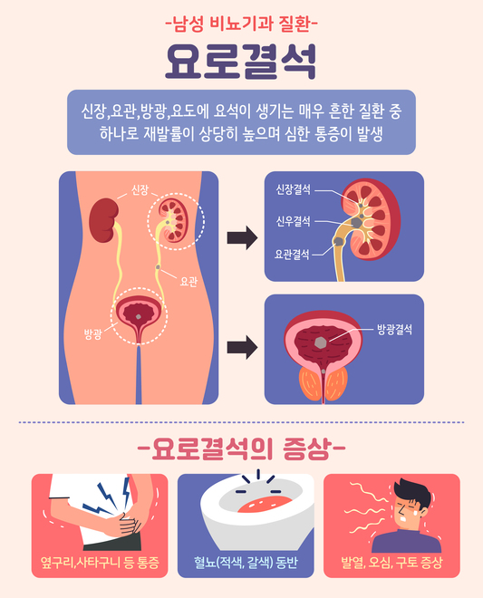 요로결석 초기 증상 놓치지 마세요 요로결석 초기 증상 놓치지 마세요