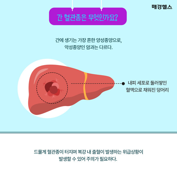 간에 생기는 가장 흔한 종양 '간 혈관종'은 무엇인가요?