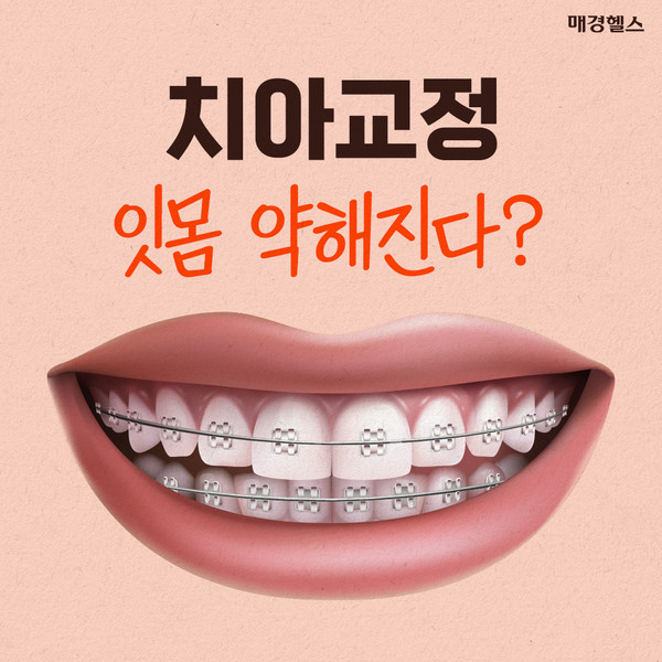 '치아 교정' 하면 잇몸 약해진다?…진실은